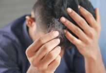 “자꾸 머리가 빠져요”…초여름 탈모, 일시적인 현상일까? a man is combing his hair with his hands